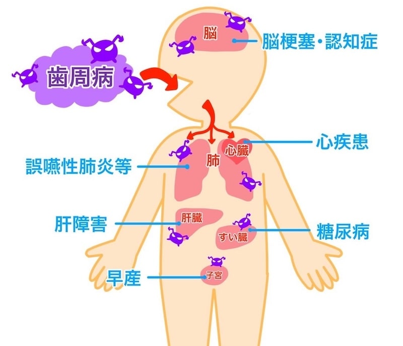 全身の健康に影響を及ぼす歯周病